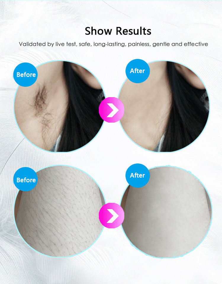 Laser Hair Removal Equipment | Koalakits36