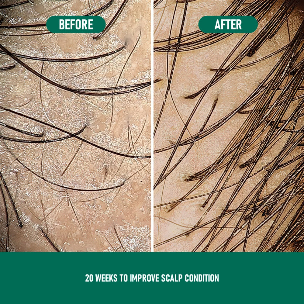 Minoxidil Anti-Hair Loss Mousse Koalakits36