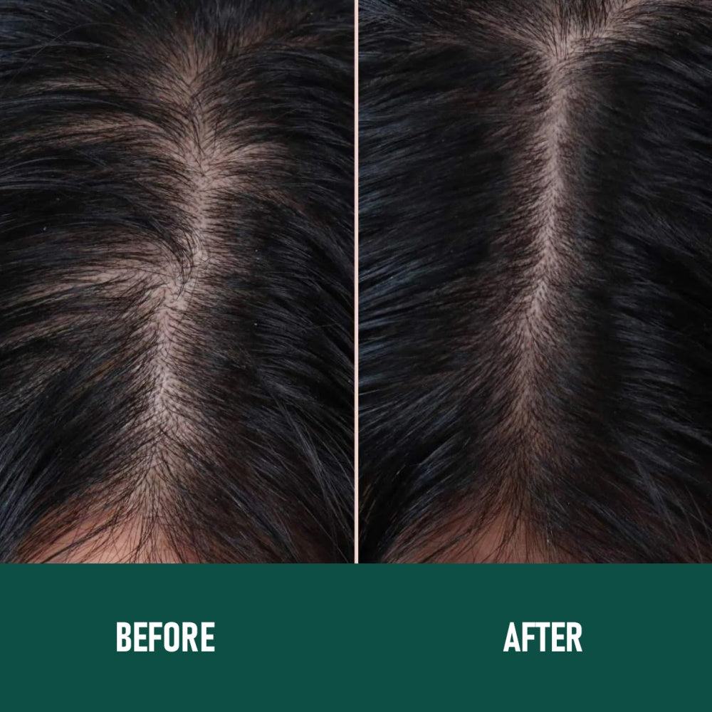 Minoxidil Anti-Hair Loss Mousse Koalakits36